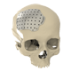 Cranioplasty Implant Solutions